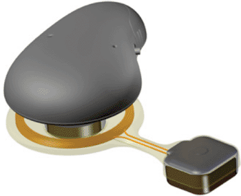 Image: The Chalmers bone conduction implant (BCI) (Photo courtesy of Emil Håkansson, Chalmers).